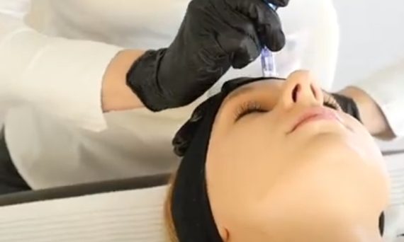 Microneedling