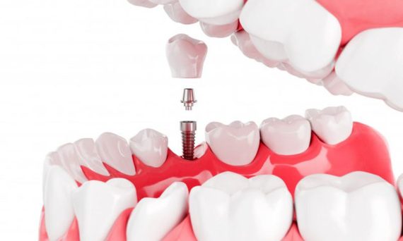 zobni implantati cenik