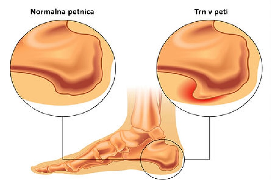 trn peta